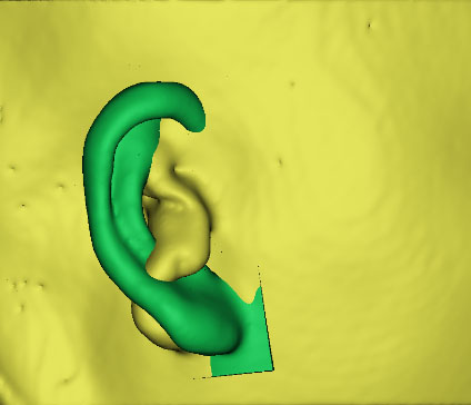 小耳畸形怎么辦？這有一份三維數(shù)字化治療方案請(qǐng)簽收！
